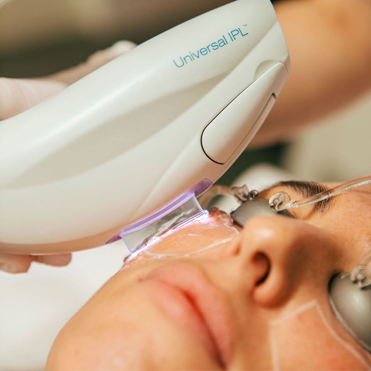IPL photo facial