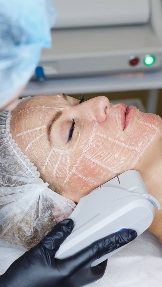 Chemical Peel